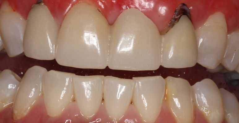 Yellowing Teeth with tartar build up and gum disease