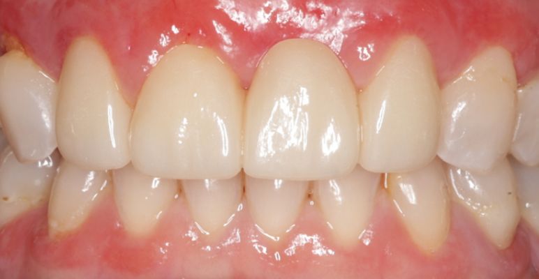 A healthy set of white teeth after treatment