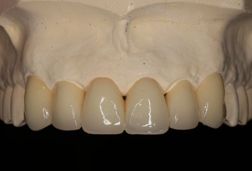 A mock-up of teeth used in demonstrations for patients.